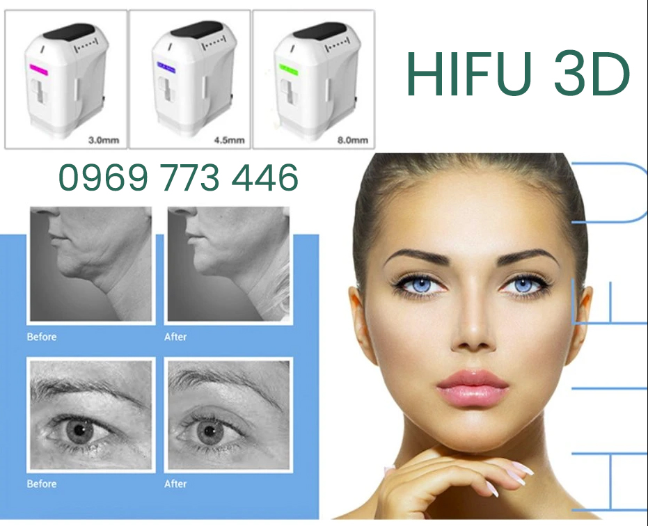 may-nang-co-hifu-3d-tre-hoa-da-tao-vline