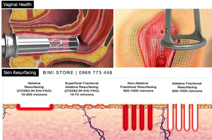 may-se-khi-am-dao-co2-fractional-fotona